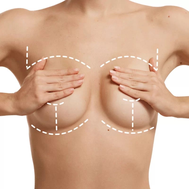 Medical illustration showing breast augmentation markings with dotted surgical guidelines for cosmetic surgery planning
