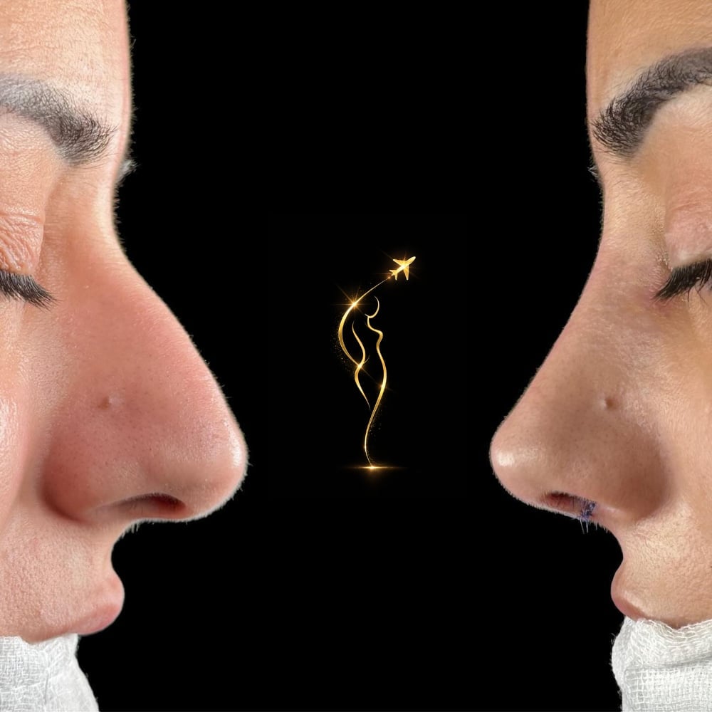 Side profile comparison of a nose before and after cosmetic surgery with a golden airplane icon symbolizing transformation